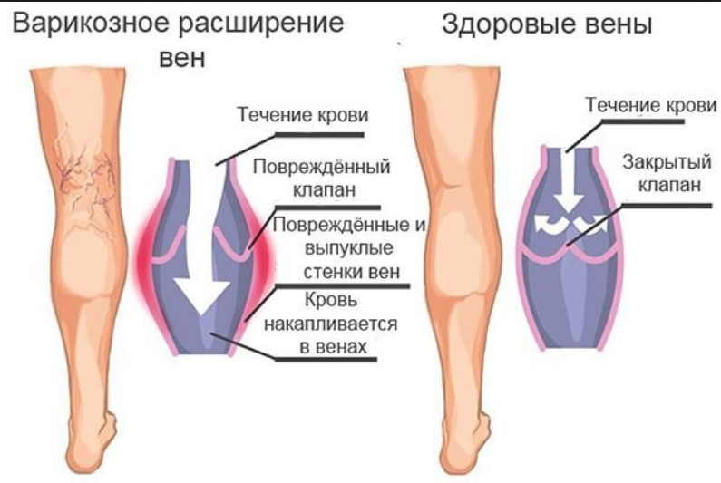 Тромбоз и варикоз можно вылечить народными способами. Мудрость предков на страже здоровья!1