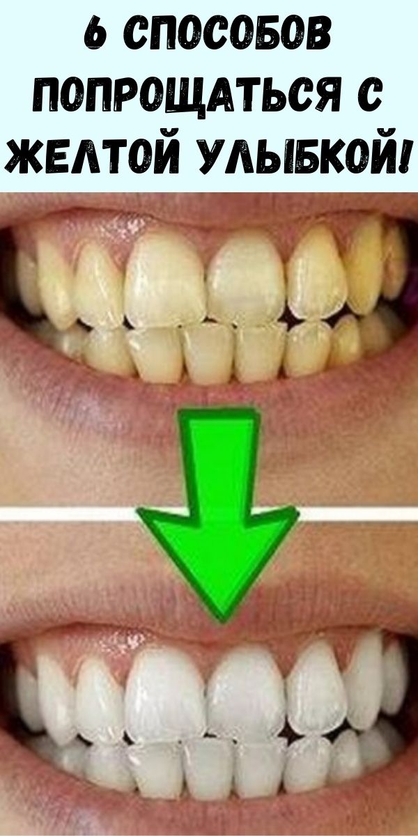 6 способов попрощаться с желтой улыбкой!